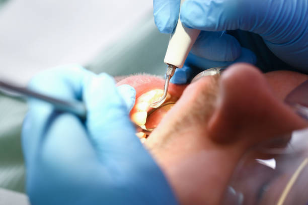Best Emergency Dental Care for Broken or Chipped Teeth in Lindenhurst, IL